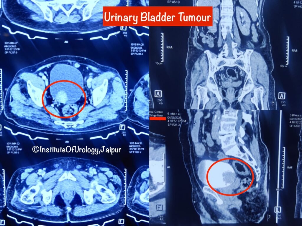 Best Hospital for Bladder Tumour Diagnosis and Treatment in Jaipur Dr M Roychowdhury Dr Rajan Bansal