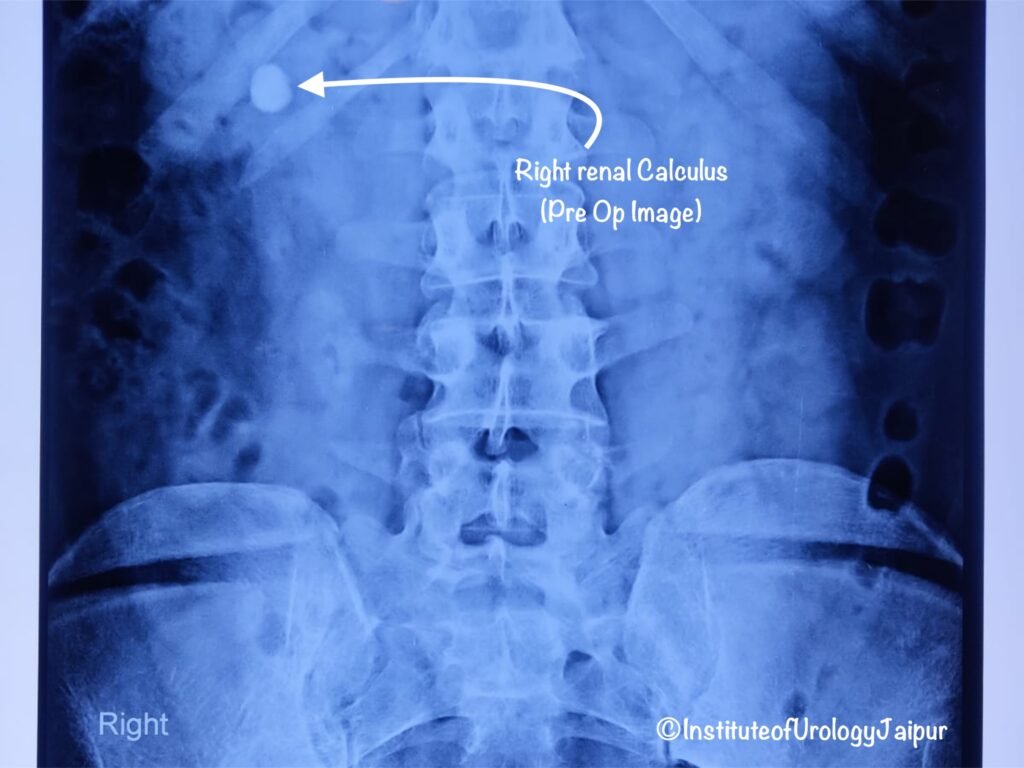 Best Hospital for Scarless Kidney Stone Treatment (RIRS) in Jaipur