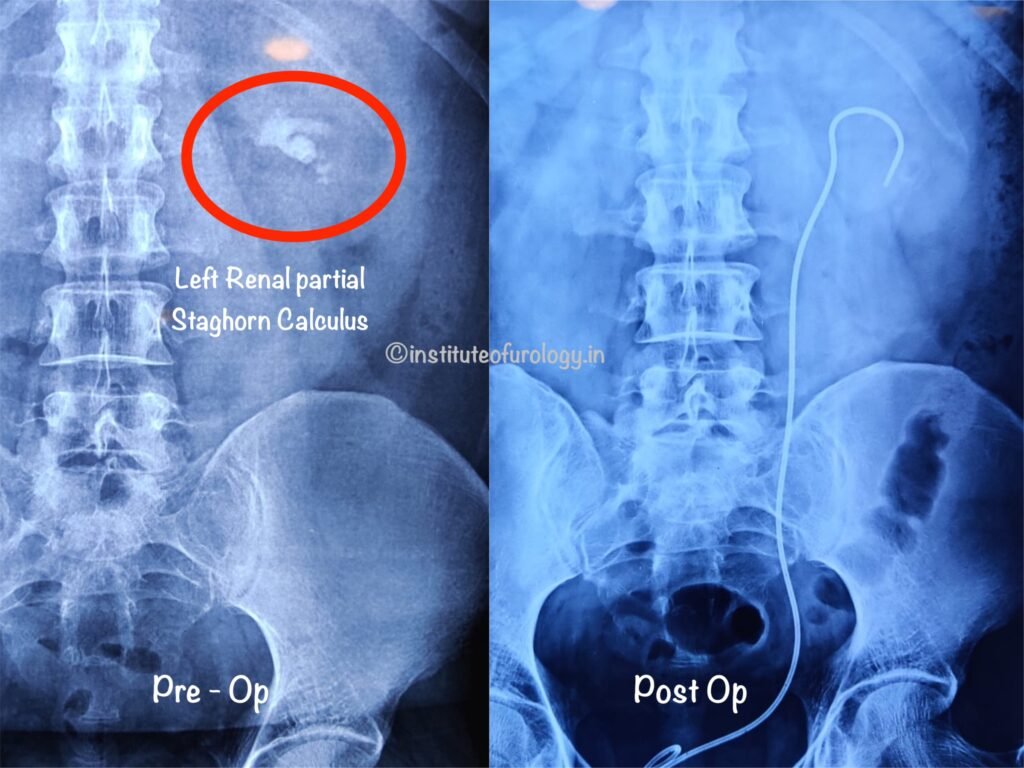 Large Staghorn Calculus treatment by rirs by no cut on the body Institute of Urology, Jaipur Dr Rajan Bansal Dr M Roychowdhury