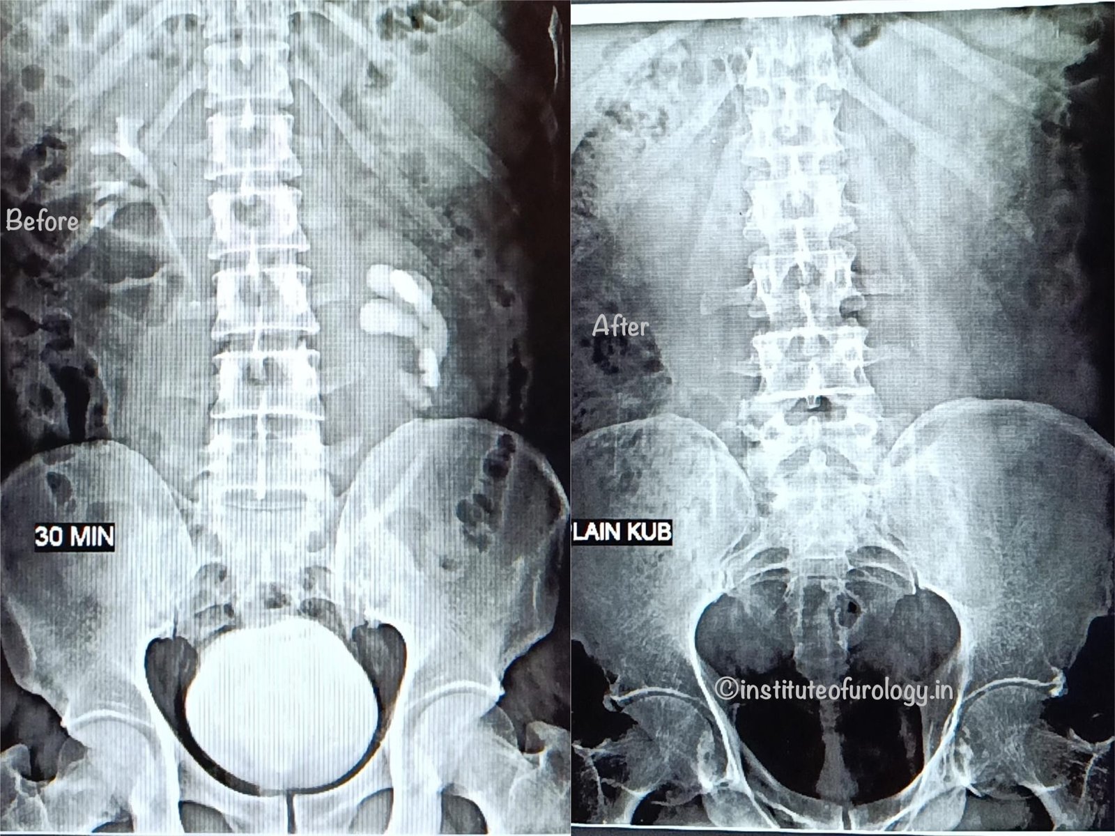 Advanced Stone Removal in Malrotated Kidney – Excellence at Institute of Urology, Jaipur Dr M Roychowdhury Dr Rajan Bansal Advanced Stone Removal in Malrotated Kidney – Excellence at Institute of Urology, Jaipur Dr M Roychowdhury Dr Rajan Bansal