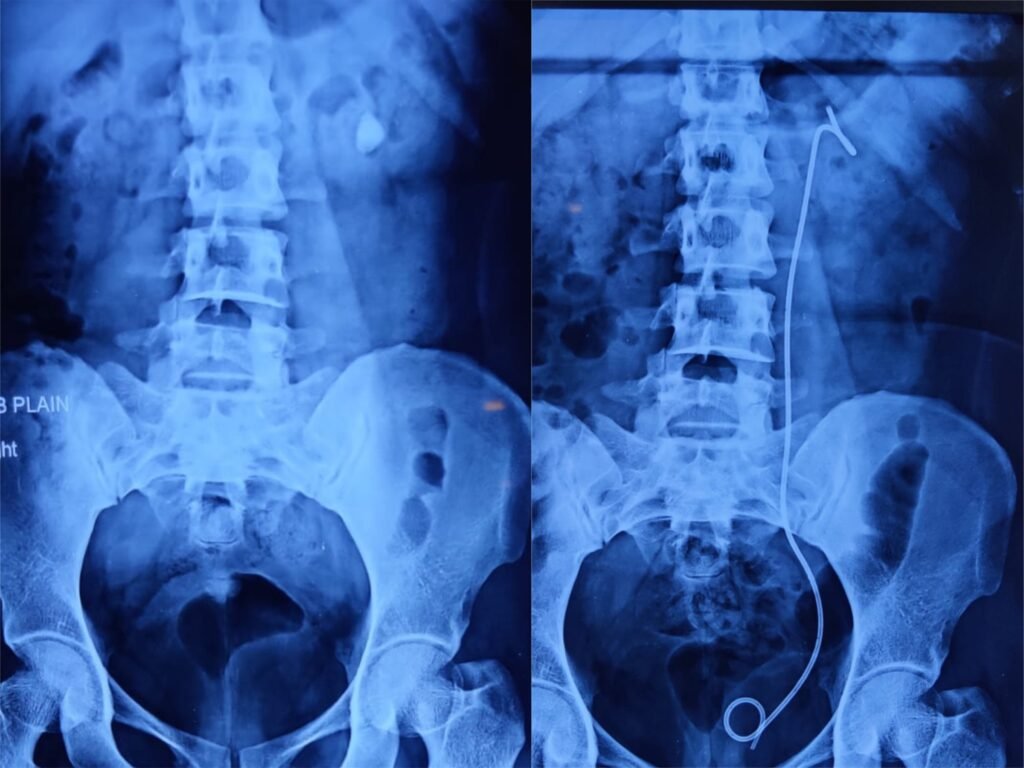 Best Hospital for Kidney Stone Treatment by PCNL in Jaipur