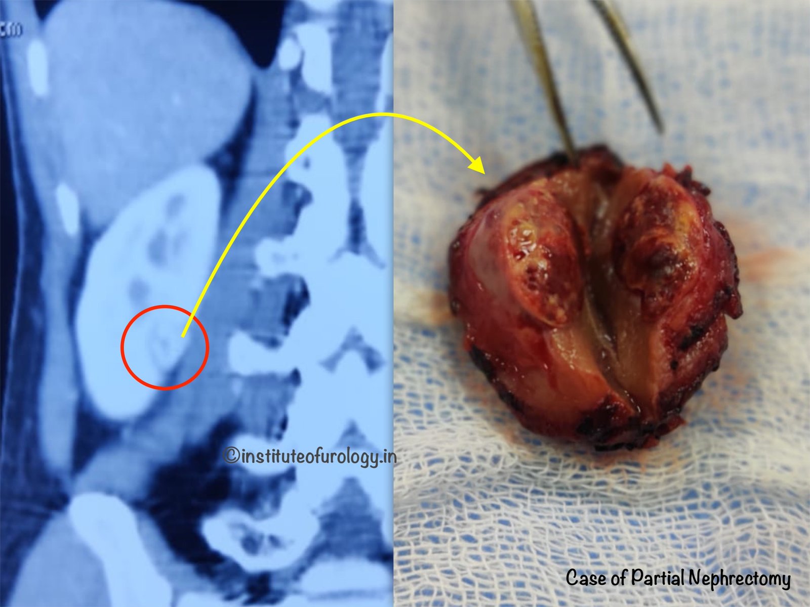 Best Hospital for Surgery of Kidney Cancer in Jaipur, Rajasthan Dr M Roychowdhury Dr Rajan Bansal
