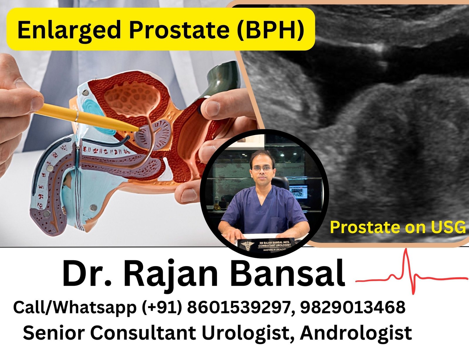Enlarged Prostate (BPH)- Symptoms Every Man Over 50 Should Watch For Dr Rajan Bansal Dr M Roychowdhury Enlarged Prostate (BPH)- Symptoms Every Man Over 50 Should Watch For Dr Rajan Bansal Dr M Roychowdhury