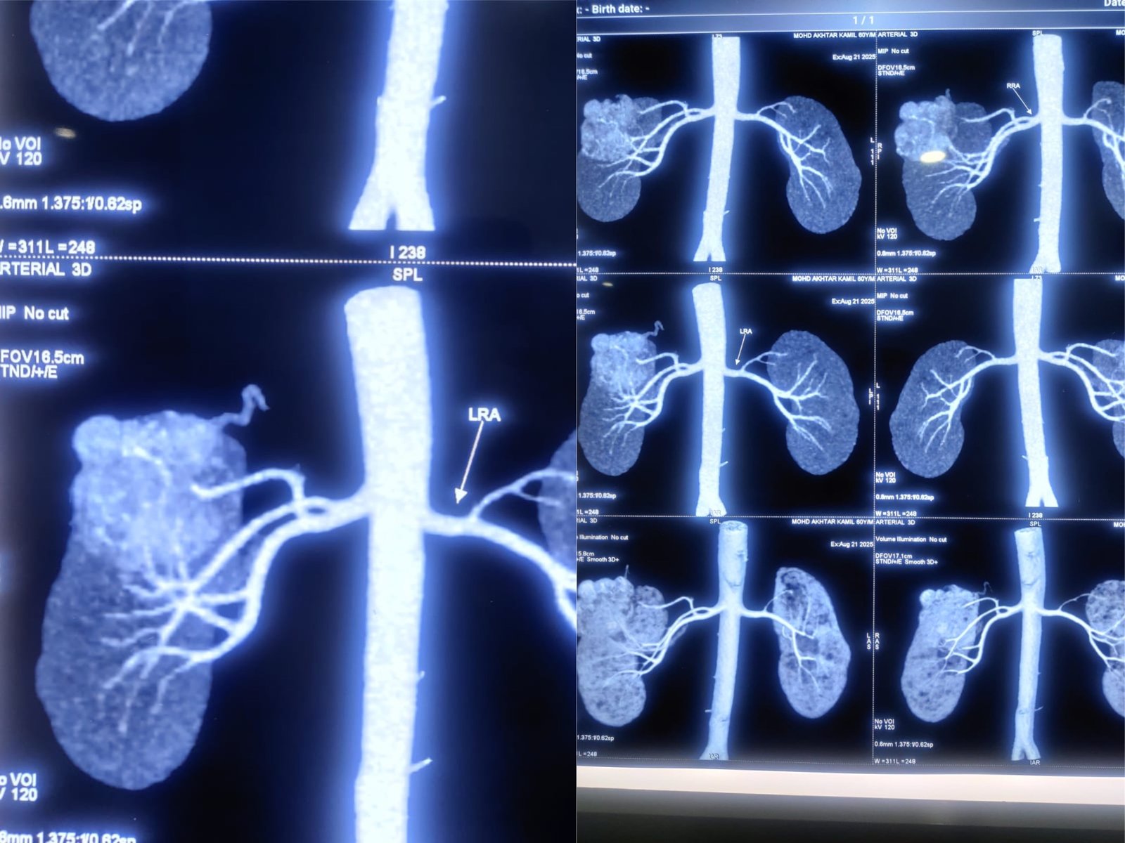 Successful Radical Nephrectomy for Right Renal Mass in a 60-Year-Old Male- A Testament to Surgical Precision at the Institute of Urology, Jaipur