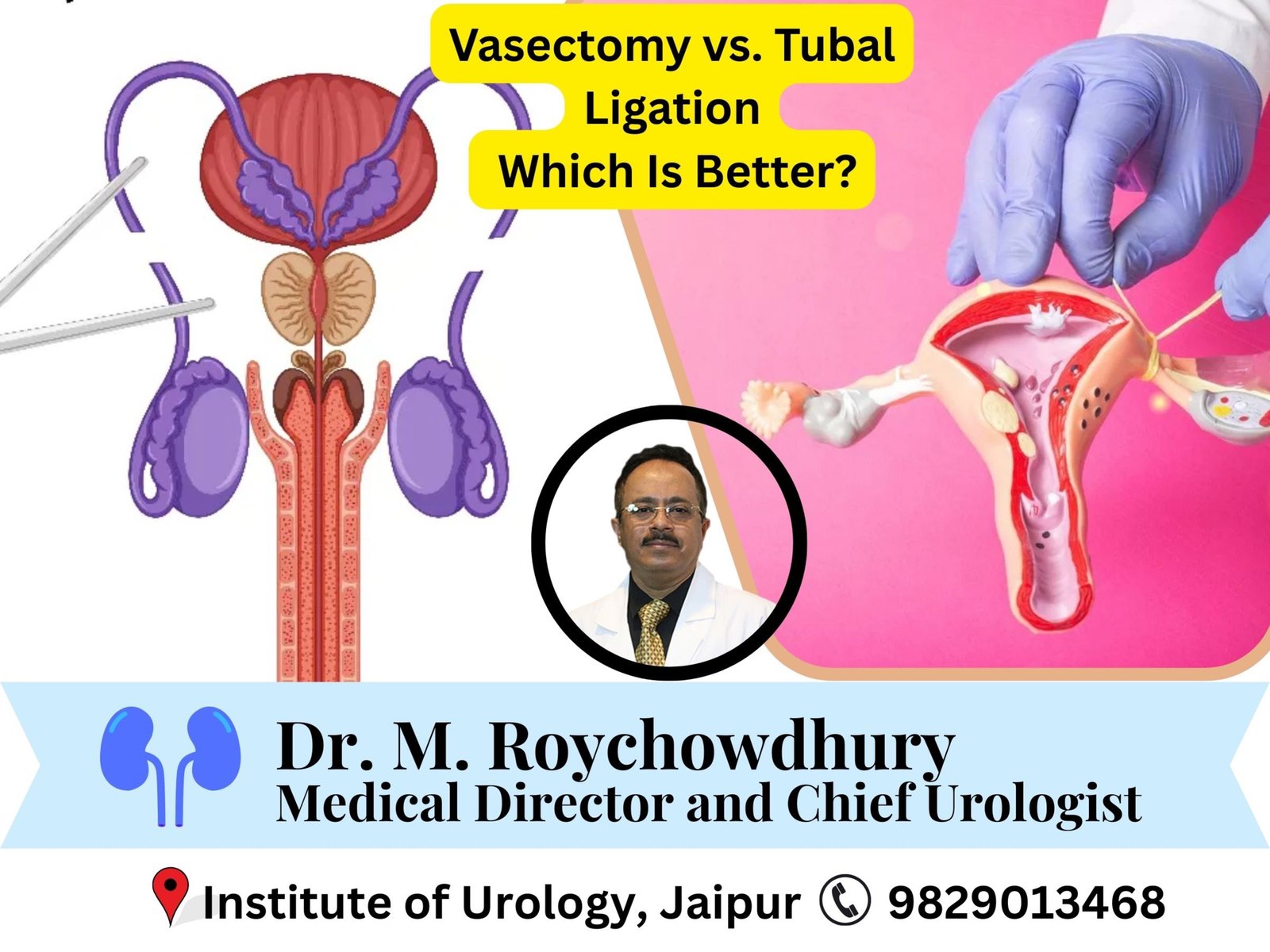 Vasectomy vs. Tubal Ligation (Tubectomy)- Which Is Better? Dr M Roychowdhury Dr Rajan Bansal Vasectomy vs. Tubal Ligation (Tubectomy)- Which Is Better? Dr M Roychowdhury Dr Rajan Bansal