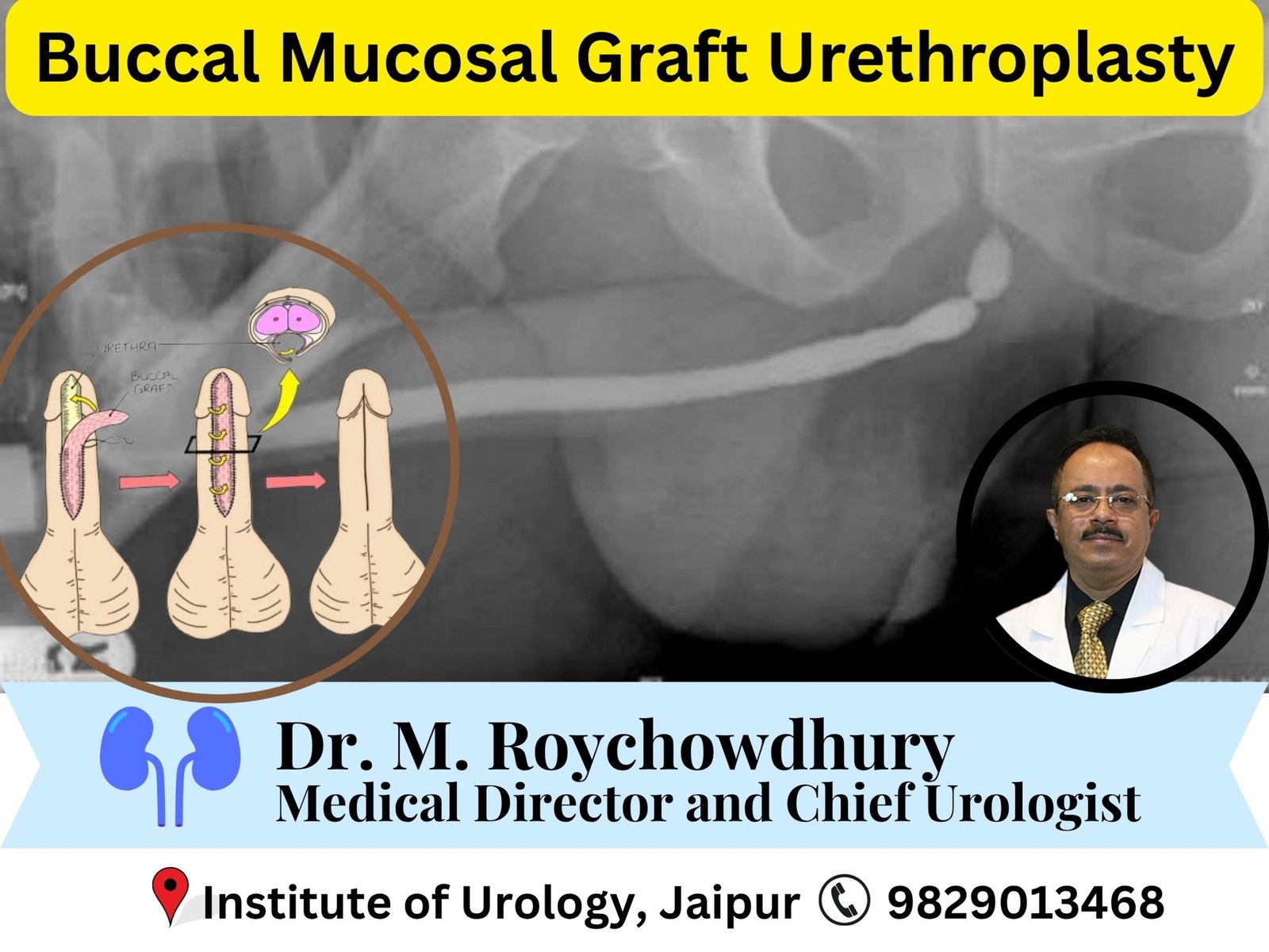 Buccal Mucosal Graft Urethroplasty Dr M Roychowdhury Jaipur Dr Rajan Bansal Buccal Mucosal Graft Urethroplasty in Jaipur