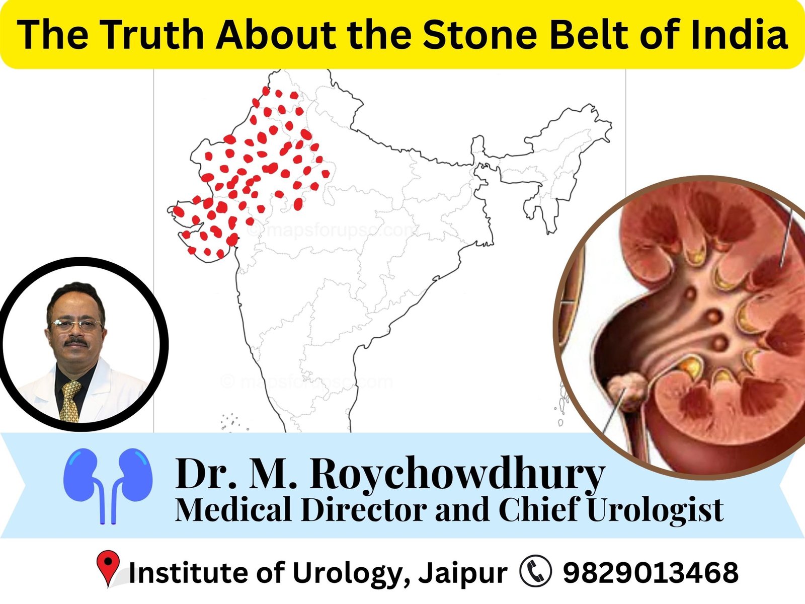 Why Are Kidney Stones Most Prevalent in Rajasthan, Gujarat and Punjab? The Truth About the Stone Belt of India Why Are Kidney Stones Most Prevalent in Rajasthan, Gujarat and Punjab? The Truth About the Stone Belt of India