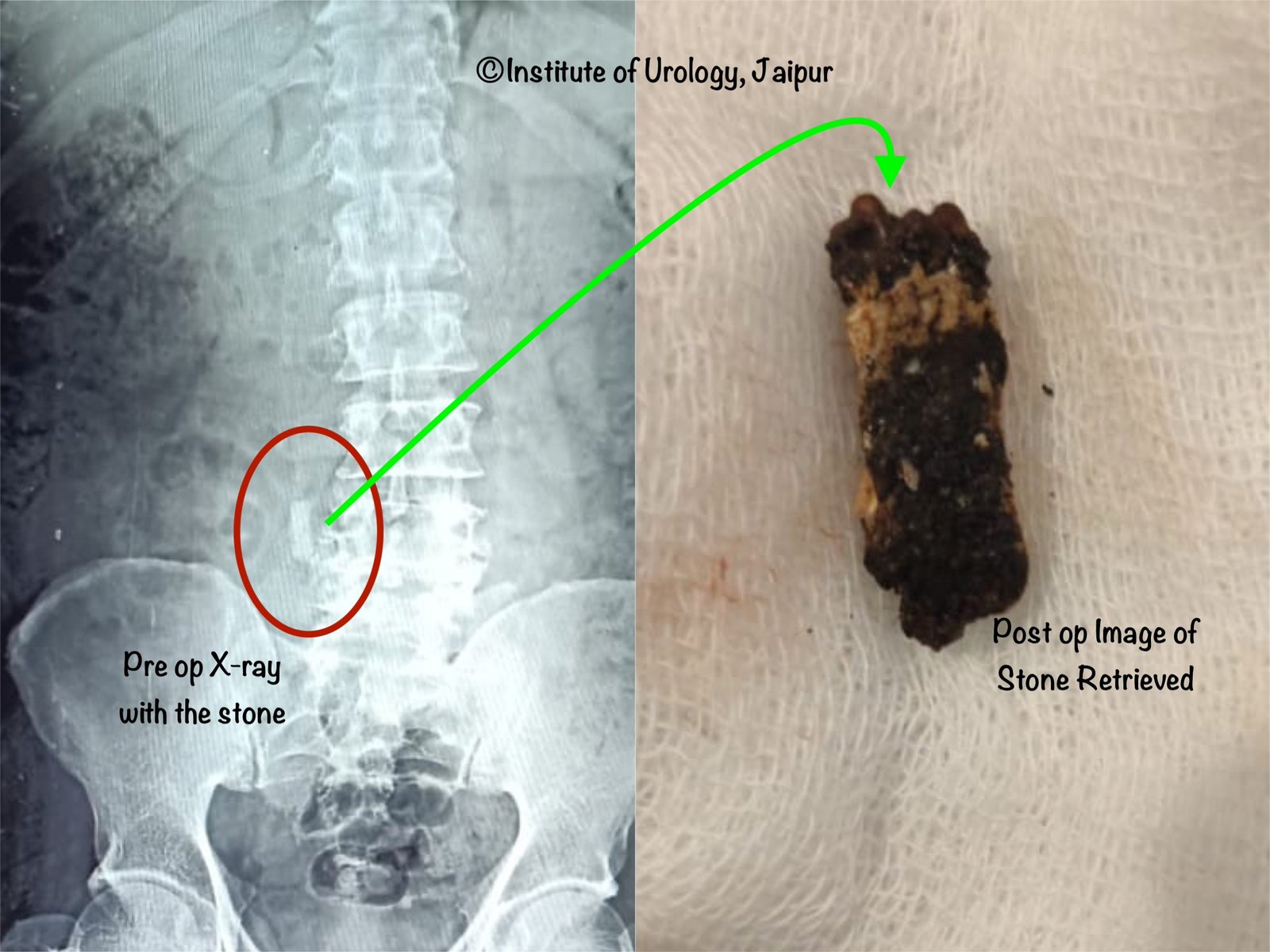 Best Hospital in India for complicated Kidney Stones Treatment - Institute of Urology, Jaipur