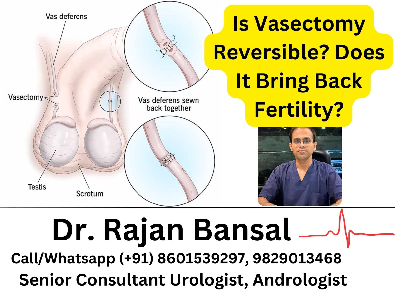 Is Vasectomy Reversible? Does It Bring Back Fertility? Dr M Roychowdhury Dr Rajan Bansal Is Vasectomy Reversible? Does It Bring Back Fertility? Dr M Roychowdhury Dr Rajan Bansal