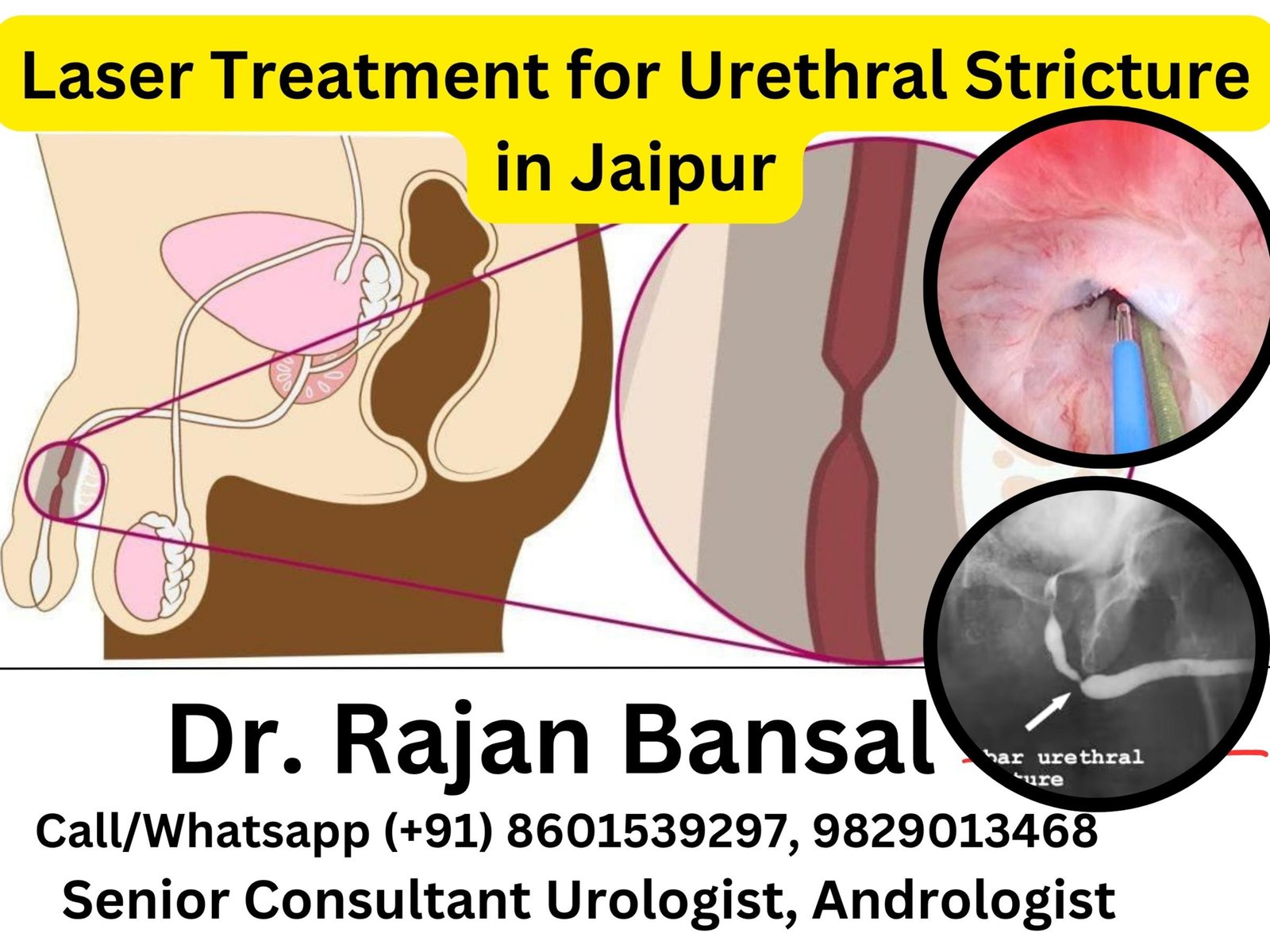 Laser Treatment for Urethral Stricture in Jaipur- The New Era of Precision Urology Dr Rajan Bansal Dr M Roychowdhury Laser Treatment for Urethral Stricture in Jaipur- The New Era of Precision Urology Dr Rajan Bansal Dr M Roychowdhury