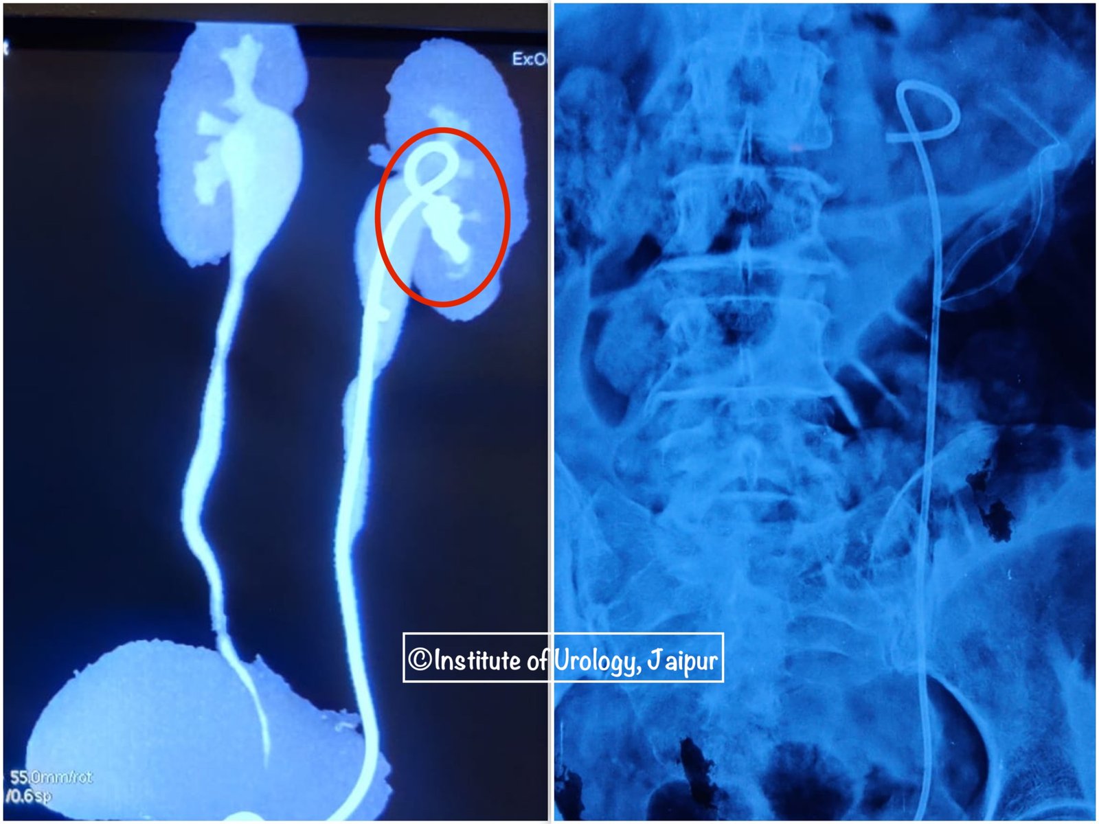 Percutaneous Nephrolithotomy (PCNL) in an Elderly Diabetic Female – A Case Report from the Institute of Urology, Jaipur