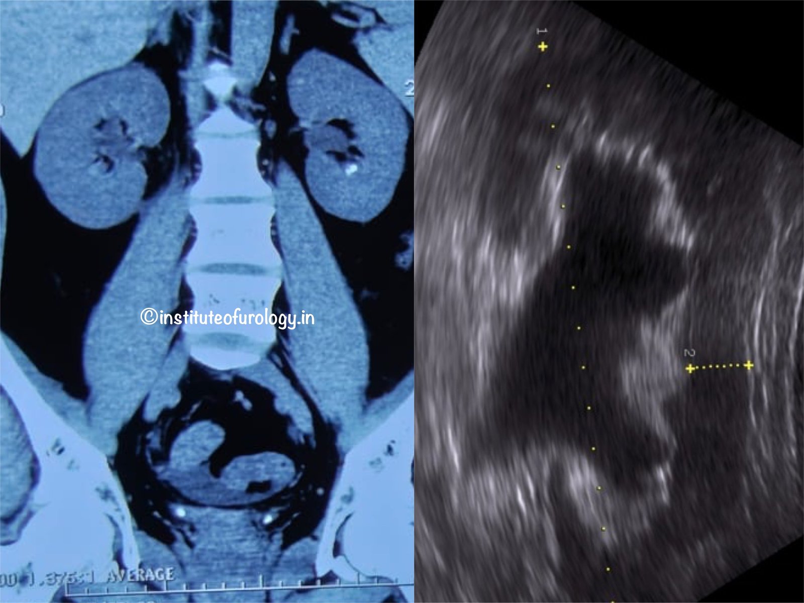 Acute Obstructive Uropathy with AKI in a young patient managed precisely by Institute of Urology, Jaipur Acute Obstructive Uropathy with AKI in a young patient managed precisely by Institute of Urology, Jaipur
