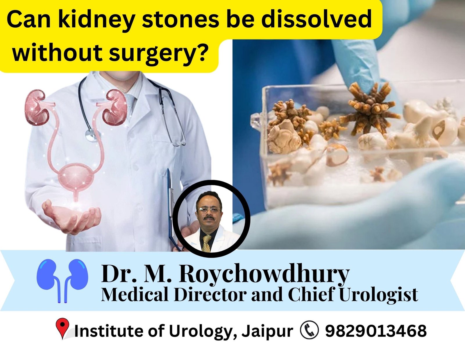 Can kidney stones be dissolved without surgery? Dr M Roychowdhury Dr Rajan Bansal Can kidney stones be dissolved without surgery? Dr M Roychowdhury Dr Rajan Bansal