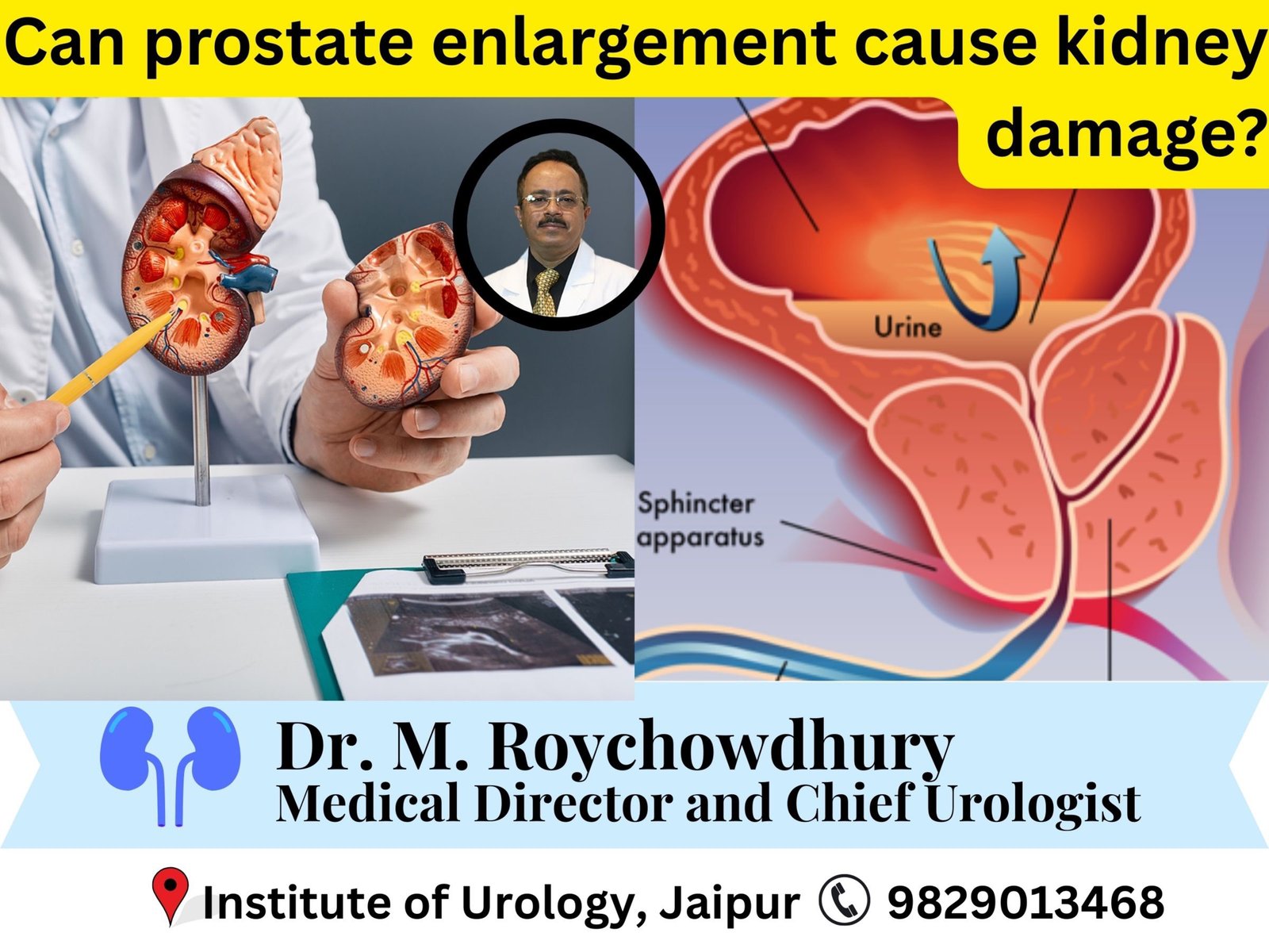 Can prostate enlargement cause kidney damage? Dr m roychowdhury dr rajan bansal Can prostate enlargement cause kidney damage? Dr m roychowdhury dr rajan bansal
