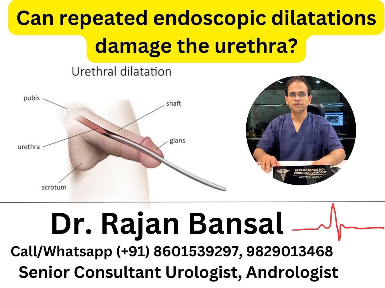 Can repeated endoscopic dilatations damage the urethra? dr rajan bansal dr m roychowdhury Can repeated endoscopic dilatations damage the urethra? dr rajan bansal dr m roychowdhury