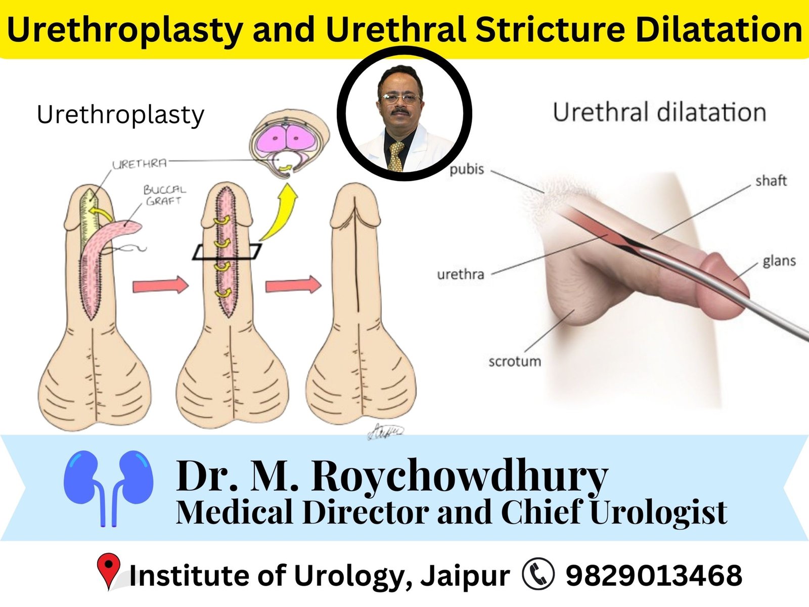 Difference between Urethroplasty and Simple Stricture Dilatation Dr M Roychowdhury Dr Rajan Bansal Difference between Urethroplasty and Simple Stricture Dilatation Dr M Roychowdhury Dr Rajan Bansal