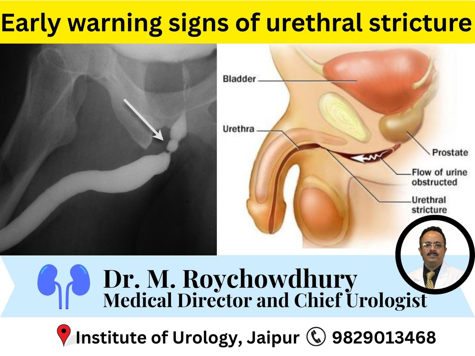 Early warning signs of urethral stricture most people ignore dr m roychowdhury dr rajan bansal Early warning signs of urethral stricture most people ignore dr m roychowdhury dr rajan bansal