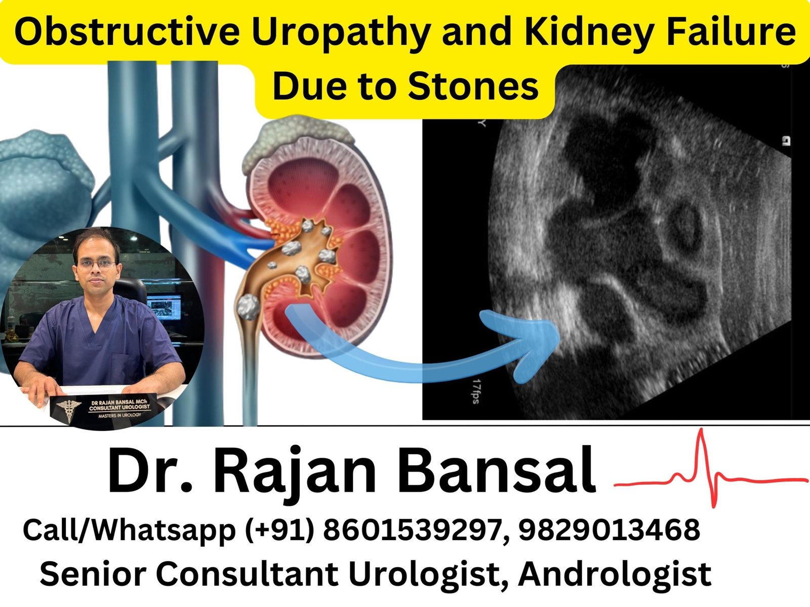 Obstructive Uropathy and Kidney Failure Due to Stones Dr Rajan Bansal Dr M Roychowdhury Obstructive Uropathy and Kidney Failure Due to Stones Dr Rajan Bansal Dr M Roychowdhury
