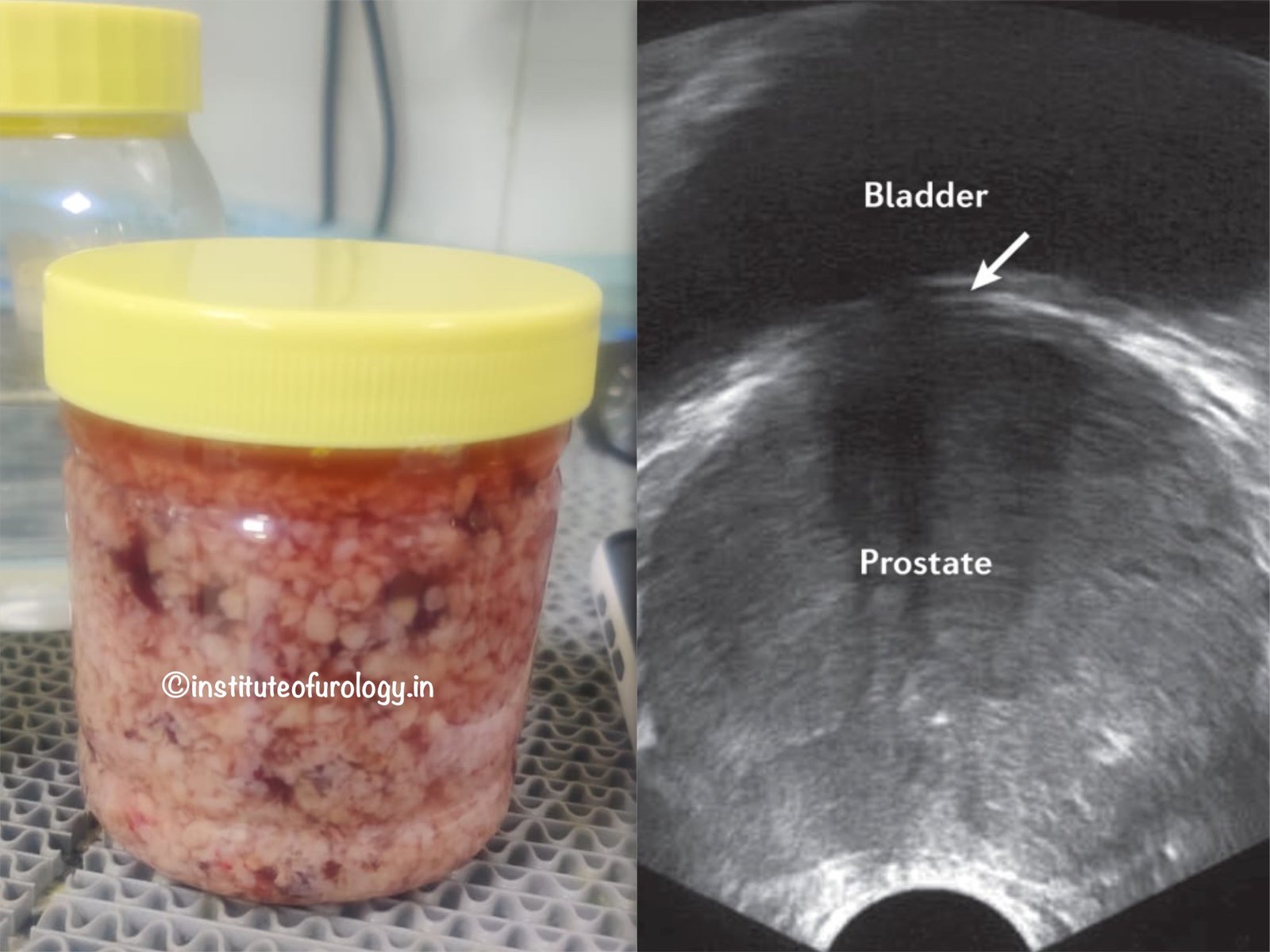 Successful Holmium Laser Enucleation of a 200 g Prostate in a Patient With Long-Standing Obstructive Urinary Symptoms Dr M Roychowdhury Dr Rajan Bansal Successful Holmium Laser Enucleation of a 200 g Prostate in a Patient With Long-Standing Obstructive Urinary Symptoms Dr M Roychowdhury Dr Rajan Bansal