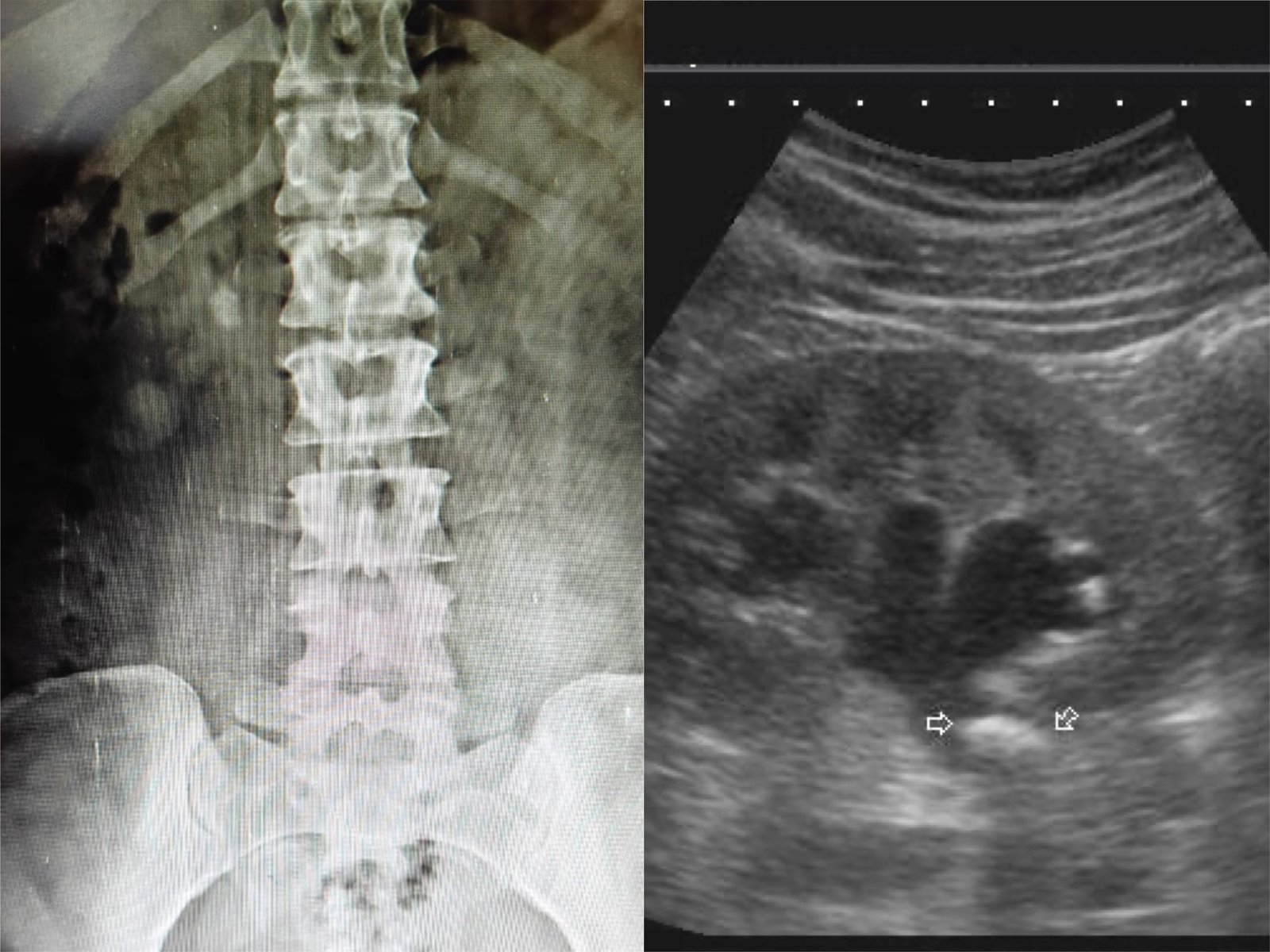 PUJ calculus treatment at Institute of urology, jaipur PUJ calculus treatment at Institute of urology, jaipur
