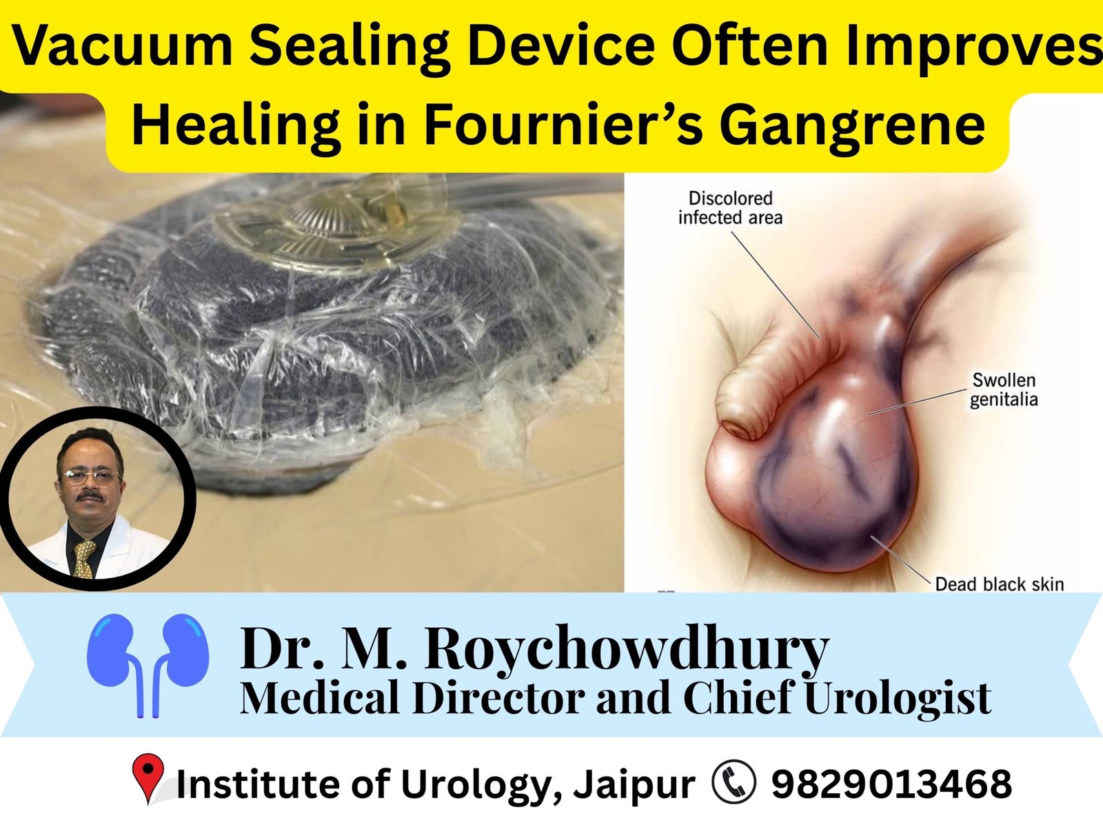 Vacuum Sealing Device Often Improves Healing in Fournier’s Gangrene Dr M Roychowdhury Dr Rajan Bansal Vacuum Sealing Device Often Improves Healing in Fournier’s Gangrene Dr M Roychowdhury Dr Rajan Bansal