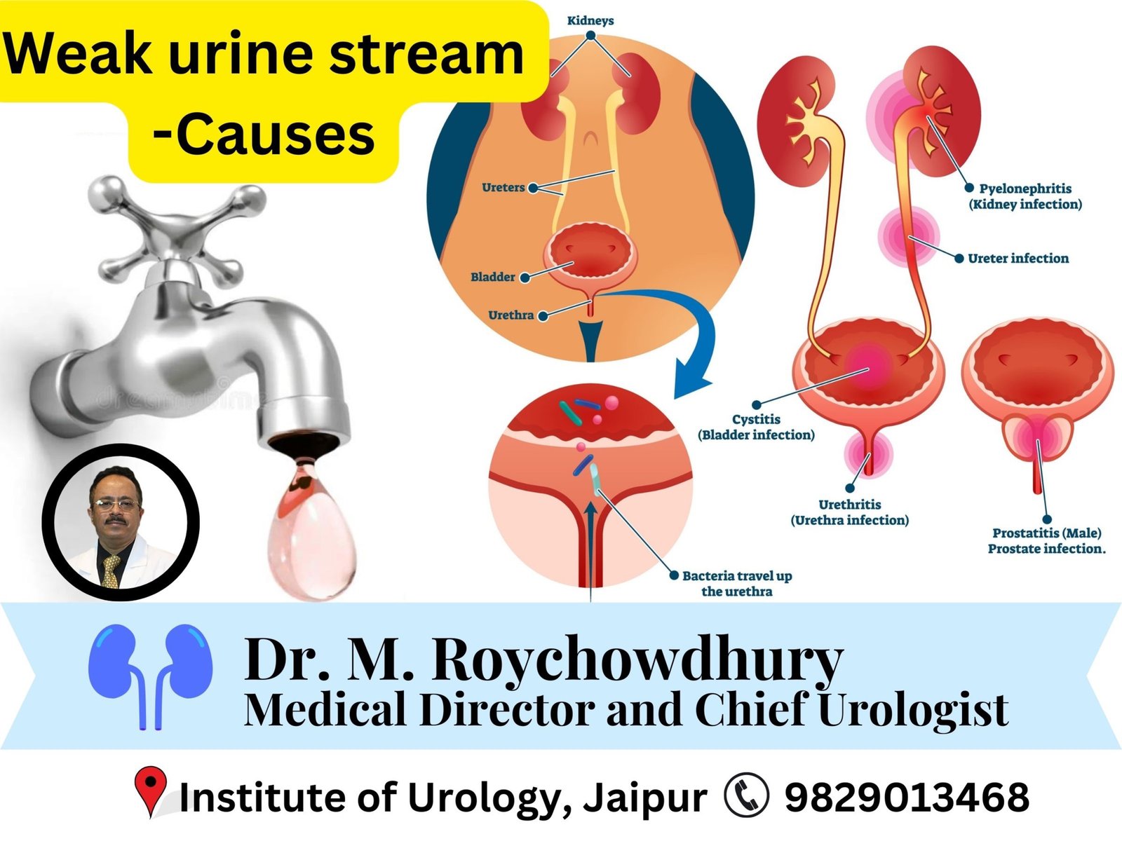 Weak urine stream — causes other than prostate Dr M Roychowdhury Dr Rajan Bansal Weak urine stream — causes other than prostate Dr M Roychowdhury Dr Rajan Bansal