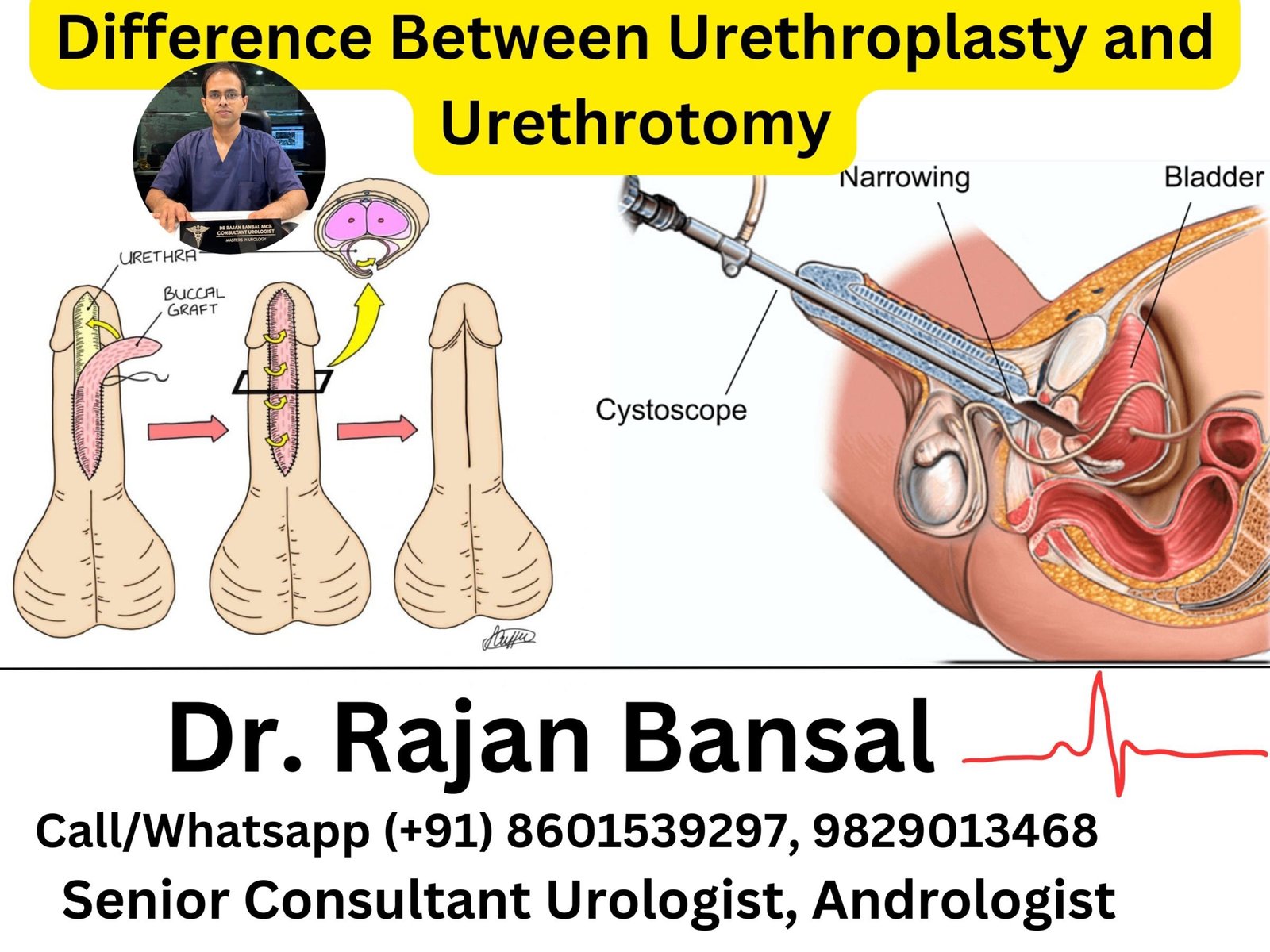What is the Difference Between Urethroplasty and Urethrotomy? What is the Difference Between Urethroplasty and Urethrotomy?