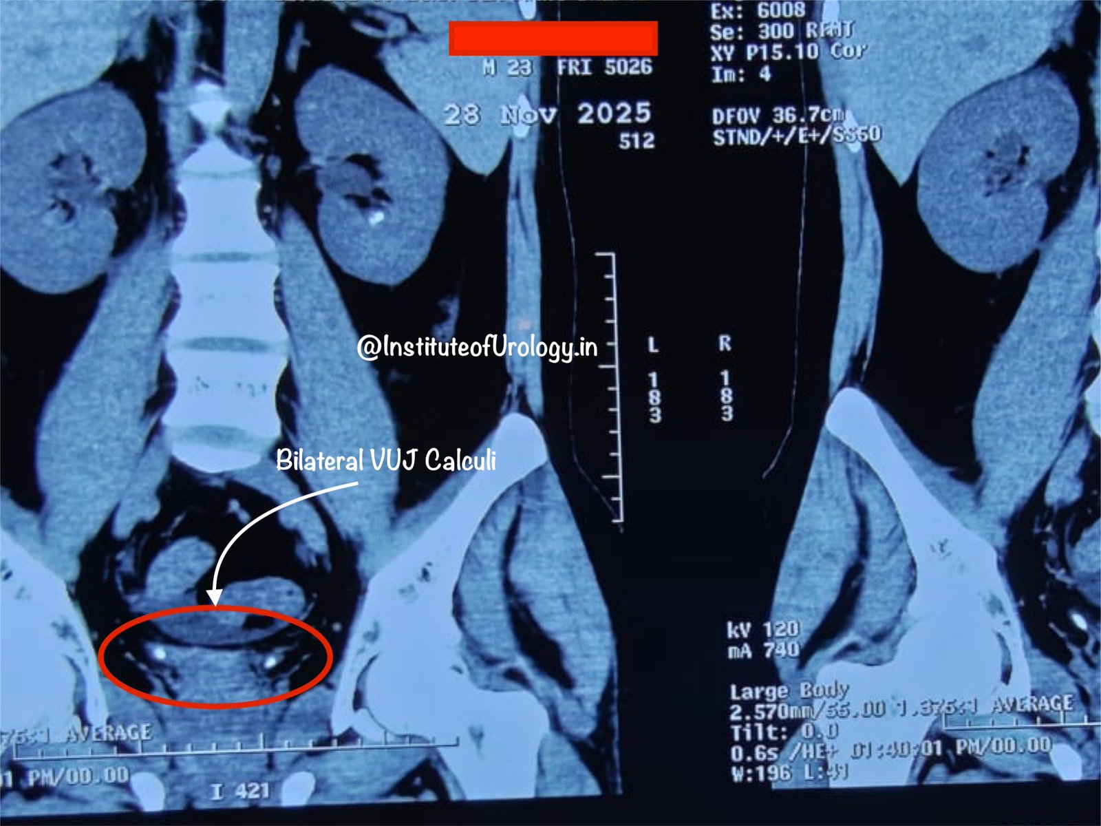 Acute Obstructive Uropathy with Anuria Due to Bilateral VUJ Calculi in a Young Male Dr M Roychowdhury Dr Rajan Bansal Acute Obstructive Uropathy with Anuria Due to Bilateral VUJ Calculi in a Young Male Dr M Roychowdhury Dr Rajan Bansal