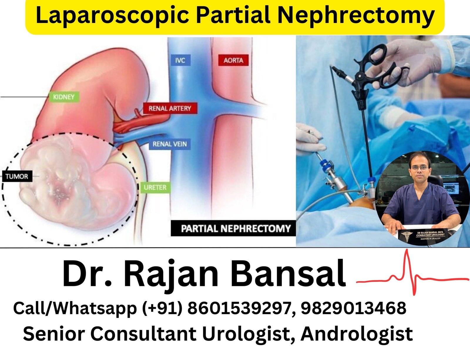 Laparoscopic Partial Nephrectomy- Preserving Renal Function Laparoscopic Partial Nephrectomy- Preserving Renal Function