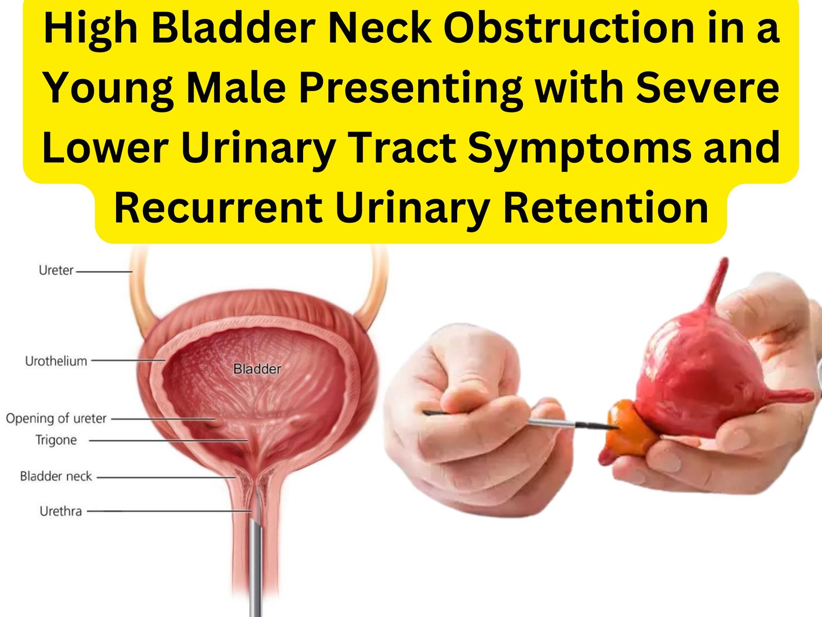 High Bladder Neck Obstruction in a Young Male Presenting with Severe Lower Urinary Tract Symptoms and Recurrent Urinary Retention High Bladder Neck Obstruction in a Young Male Presenting with Severe Lower Urinary Tract Symptoms and Recurrent Urinary Retention
