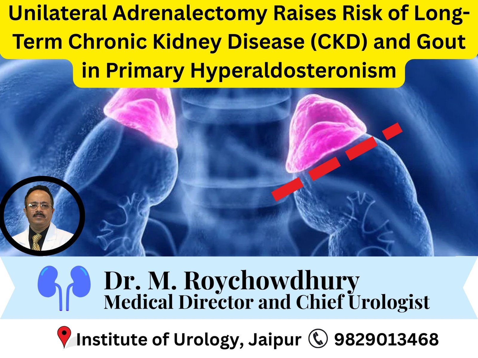 Unilateral Adrenalectomy Raises Risk of Long-Term Chronic Kidney Disease (CKD) and Gout in Primary Hyperaldosteronism dr m roychowdhury dr rajan bansal Unilateral Adrenalectomy Raises Risk of Long-Term Chronic Kidney Disease (CKD) and Gout in Primary Hyperaldosteronism dr m roychowdhury dr rajan bansal