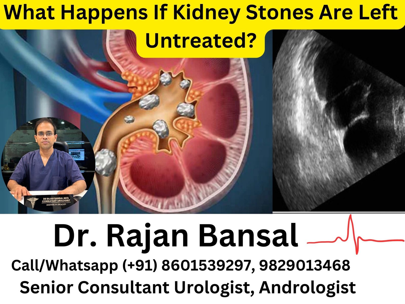 What Happens If Kidney Stones Are Left Untreated? Dr M Roychowdhury Dr Rajan Bansal What Happens If Kidney Stones Are Left Untreated? Dr M Roychowdhury Dr Rajan Bansal