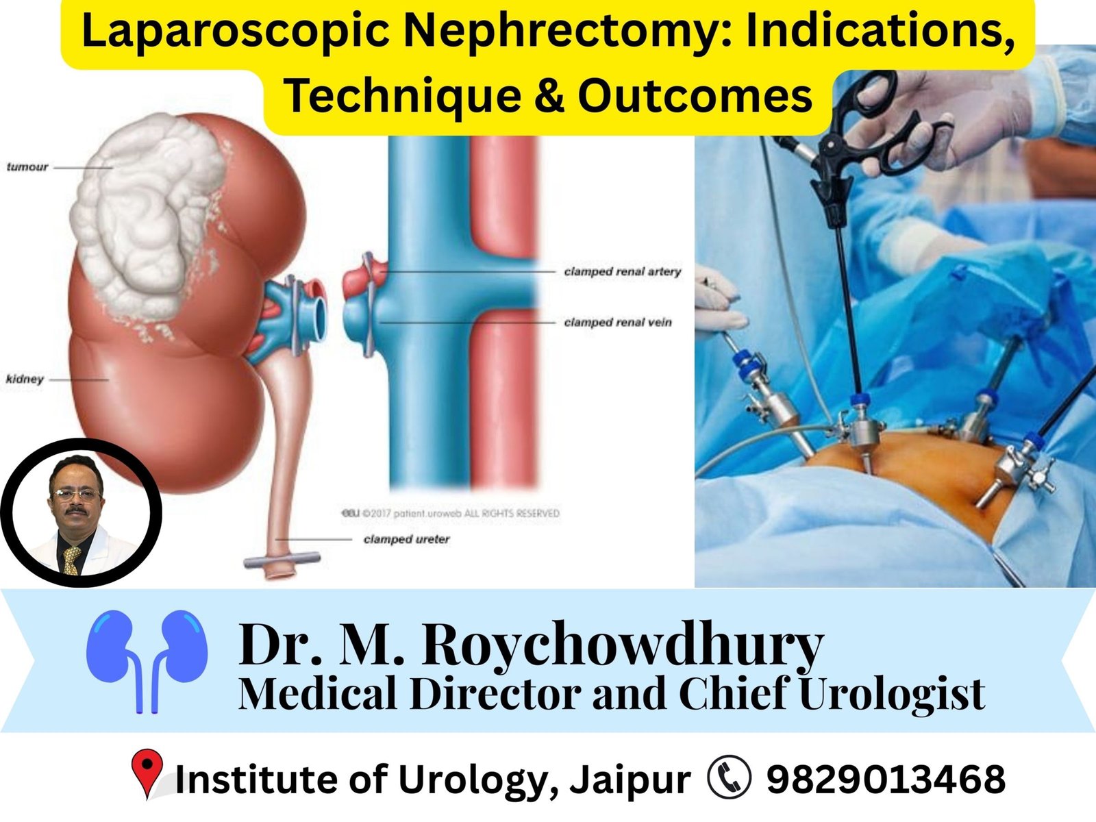 Laparoscopic Nephrectomy- Indications, Technique & Outcomes Laparoscopic Nephrectomy- Indications, Technique & Outcomes