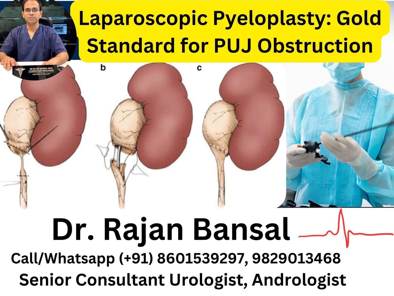 Laparoscopic Pyeloplasty- Gold Standard for PUJ Obstruction Dr Rajan Bansal Dr M Roychowdhury Laparoscopic Pyeloplasty- Gold Standard for PUJ Obstruction Dr Rajan Bansal Dr M Roychowdhury