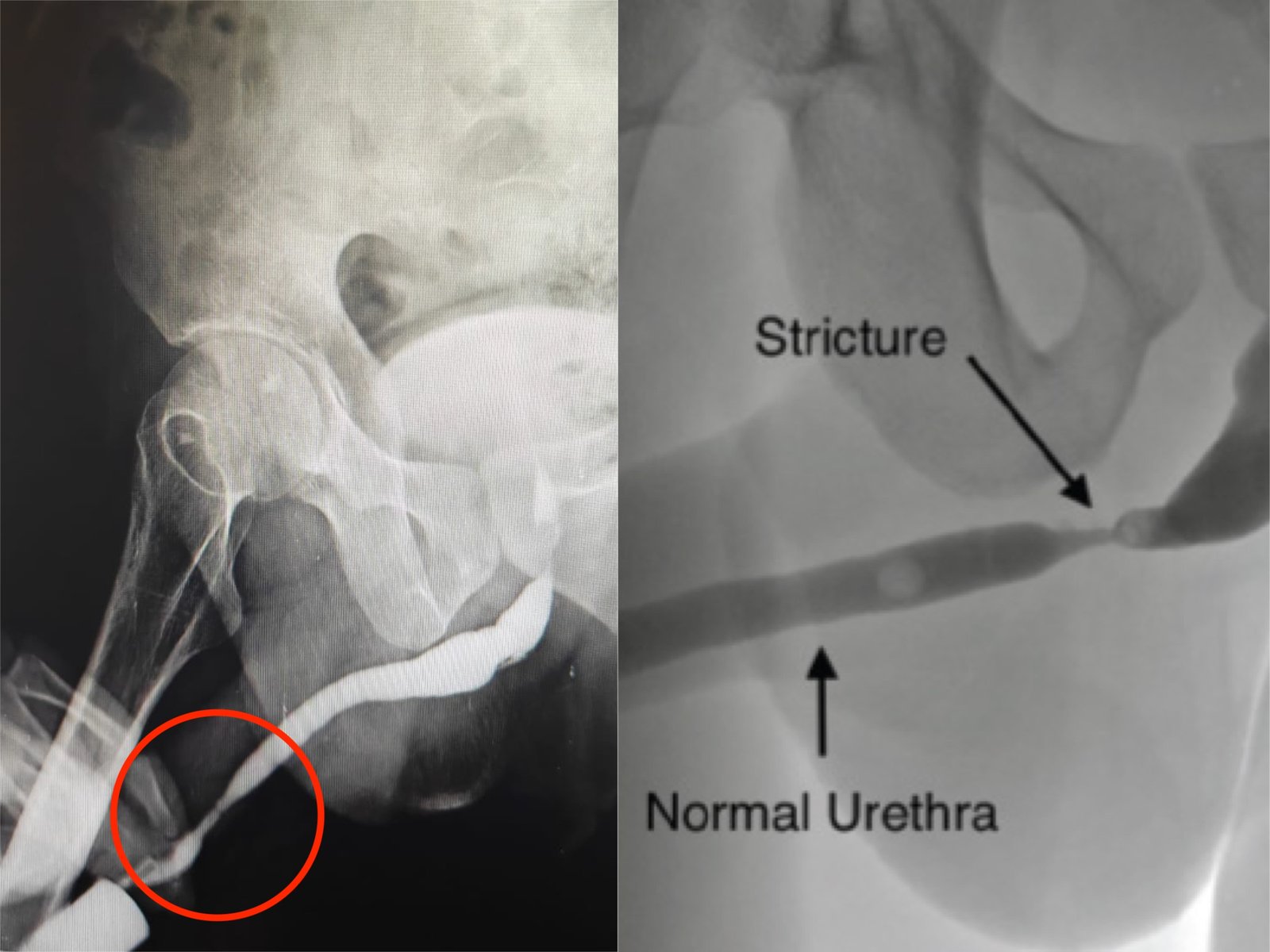 Orandi’s Urethroplasty for Distal Penile Urethral Stricture at Institute of Urology, Jaipur Orandi’s Urethroplasty for Distal Penile Urethral Stricture at Institute of Urology, Jaipur