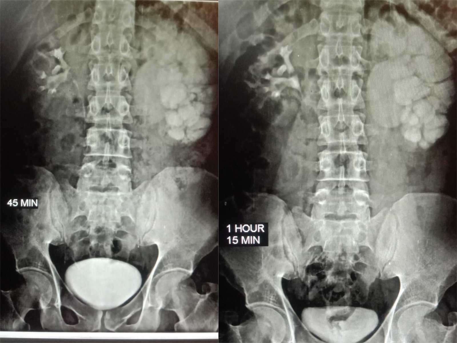 PUJ Obstruction Treatment at Institute of Urology, Jaipur by Laproscopic Pyeloplasty PUJ Obstruction Treatment at Institute of Urology, Jaipur by Laproscopic Pyeloplasty