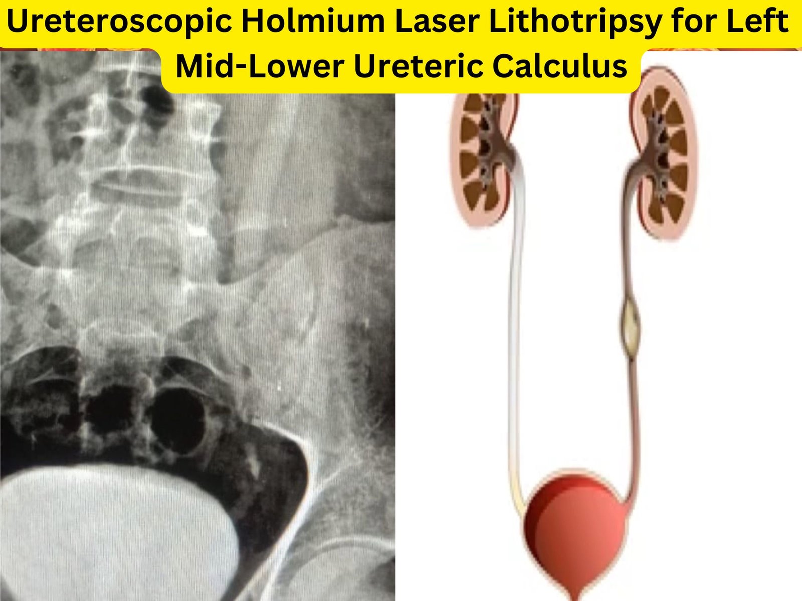 Ureteroscopic Holmium Laser Lithotripsy for Left Mid-Lower Ureteric Calculus Dr rajan bansal dr m roychowdhury Ureteroscopic Holmium Laser Lithotripsy for Left Mid-Lower Ureteric Calculus Dr rajan bansal dr m roychowdhury