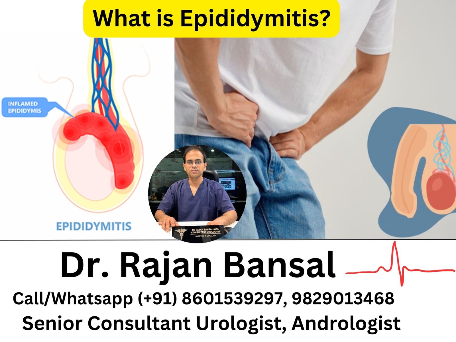 What is Epididymitis? A Complete Guide Dr M Roychowdhury Dr Rajan Bansal What is Epididymitis? A Complete Guide Dr M Roychowdhury Dr Rajan Bansal