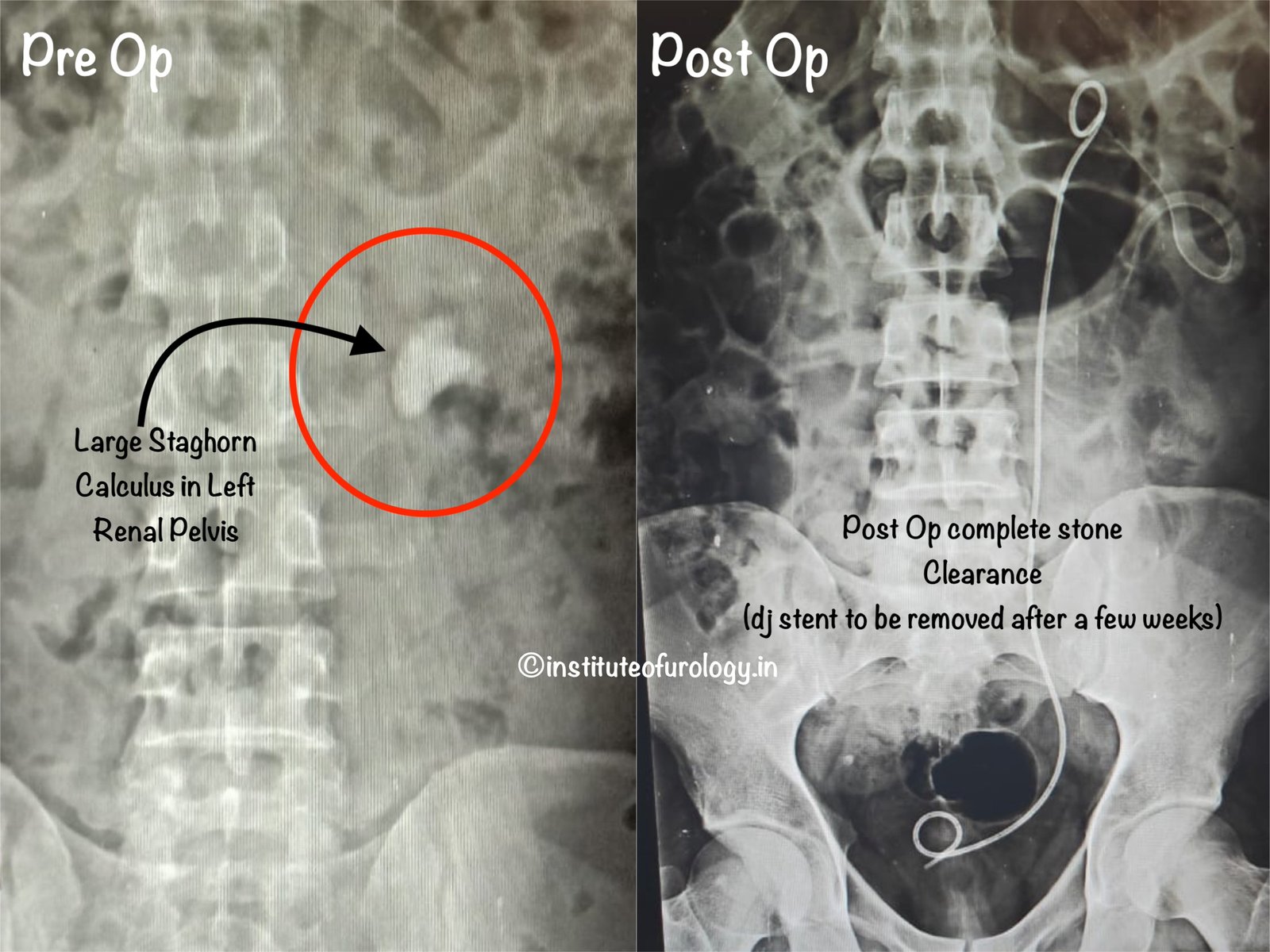 Best Hospital for Large stone surgery PCNL Institute of Urology, Jaipur Best Hospital for Large stone surgery PCNL Institute of Urology, Jaipur