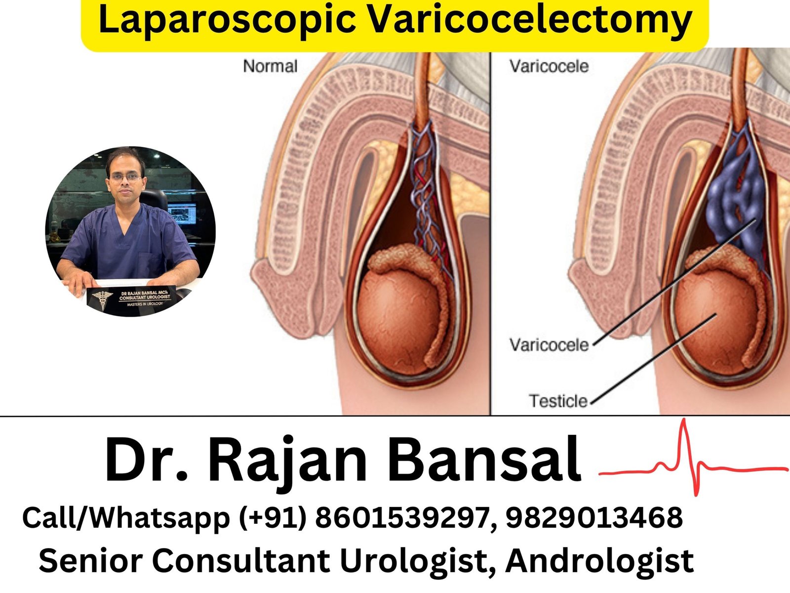 Laparoscopic Varicocelectomy- Principles, Technique, Outcomes and Clinical Significance in Male Infertility. Laparoscopic Varicocelectomy- Principles, Technique, Outcomes and Clinical Significance in Male Infertility.