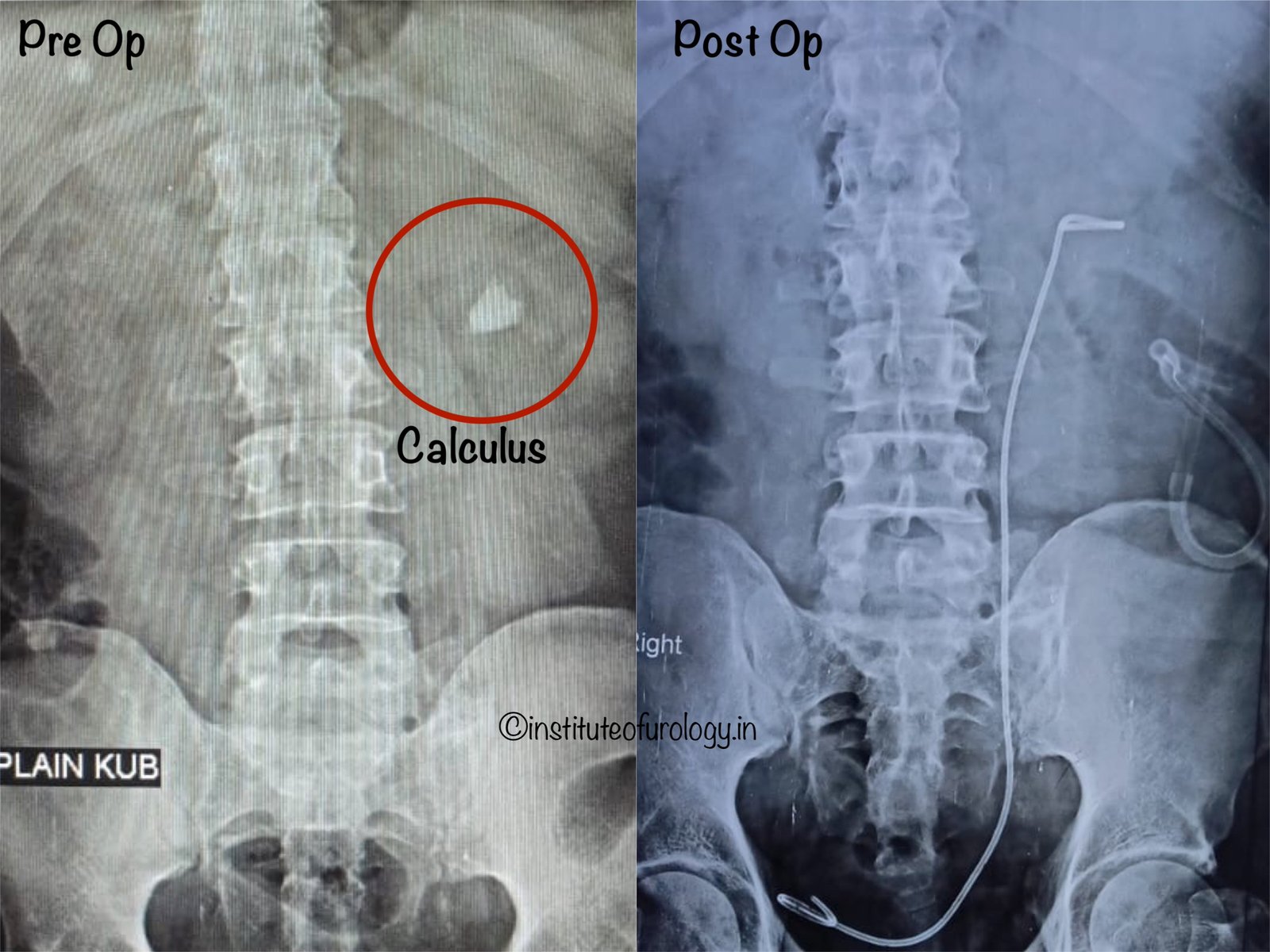 Percutaneous Nephrolithotomy for Large Renal Pelvic Calculus in a High-Risk Patient