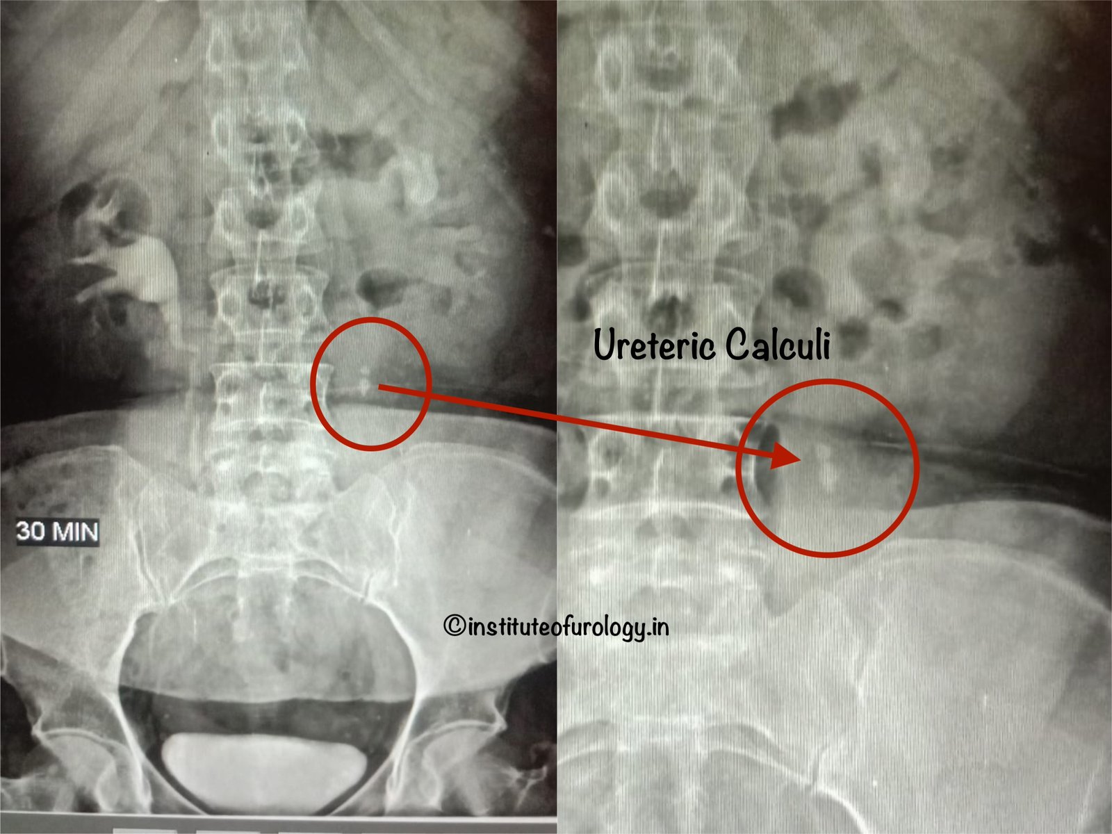 RIRS for Upper Ureteric Calculus with Hydronephrosis RIRS for Upper Ureteric Calculus with Hydronephrosis