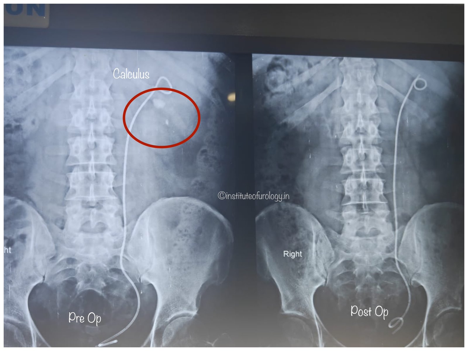 Successful Management of Left Renal Pelvic and Lower Calyceal Calculi Using Flexible Ureteroscopy (RIRS) Following Prior DJ Stenting