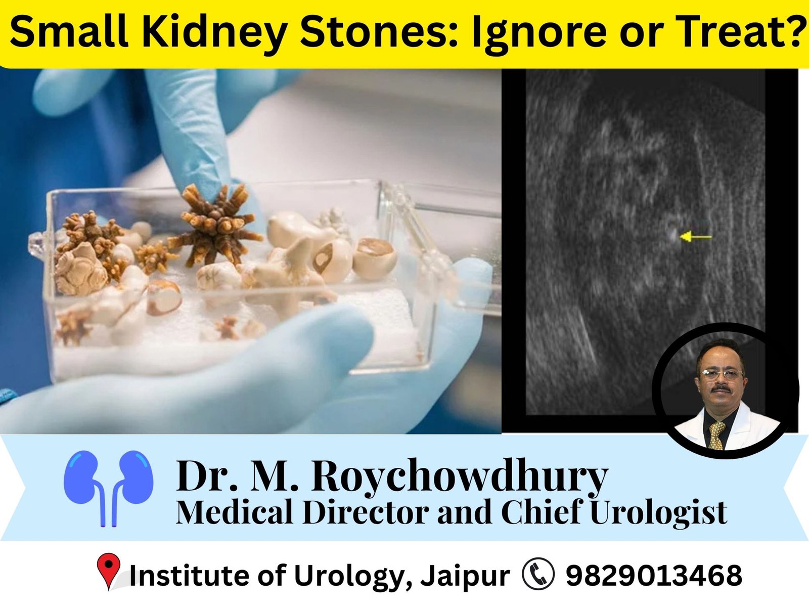 Small Kidney Stones- Ignore or Treat? The Truth Every Patient Should Know