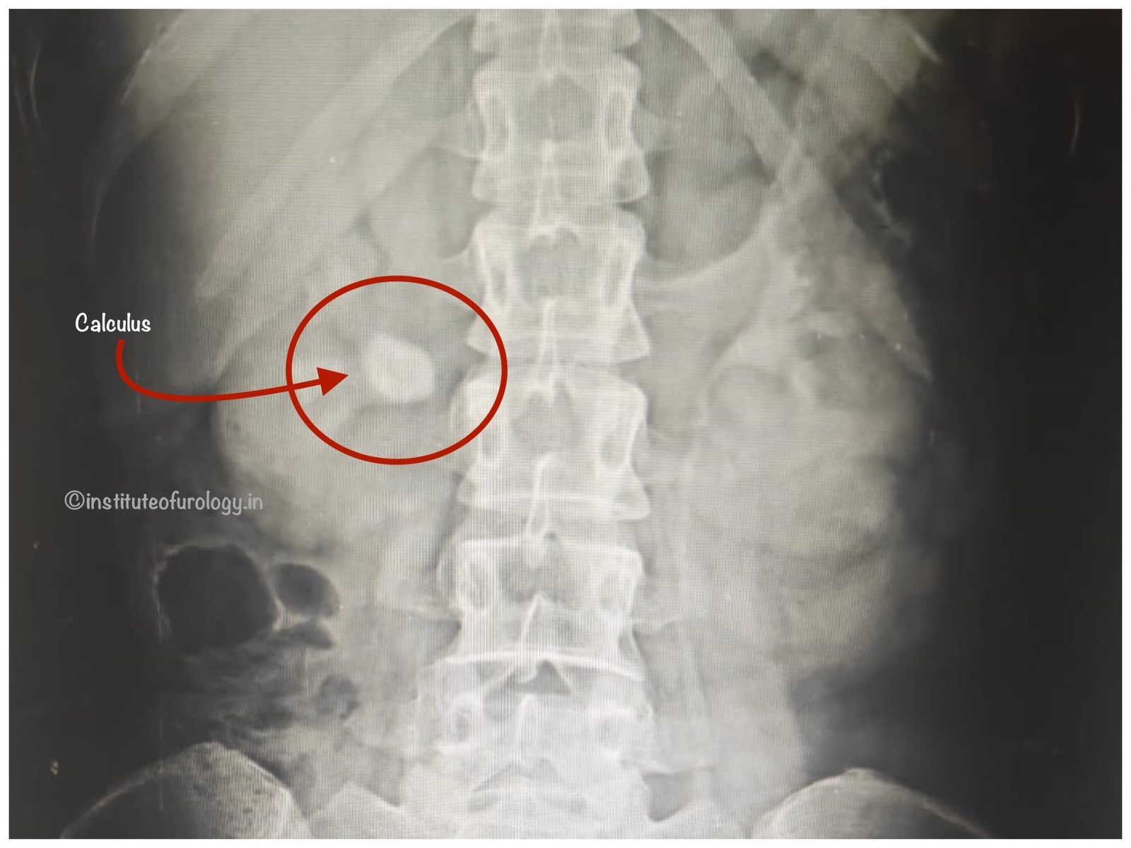 rirs for 20 mm right renal calculus